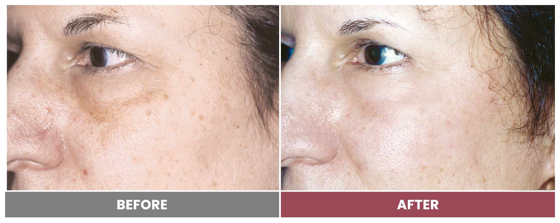LASER SKIN RESURFACING - Case 12